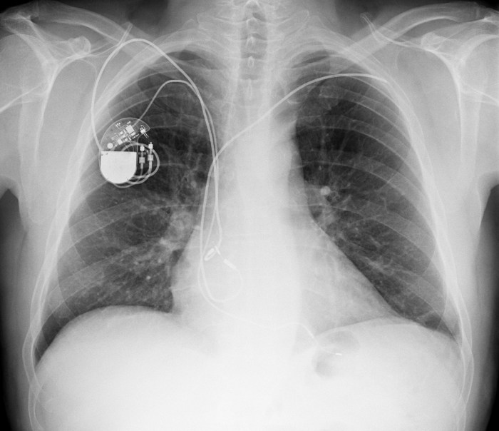Can coughing dislodge a pacemaker